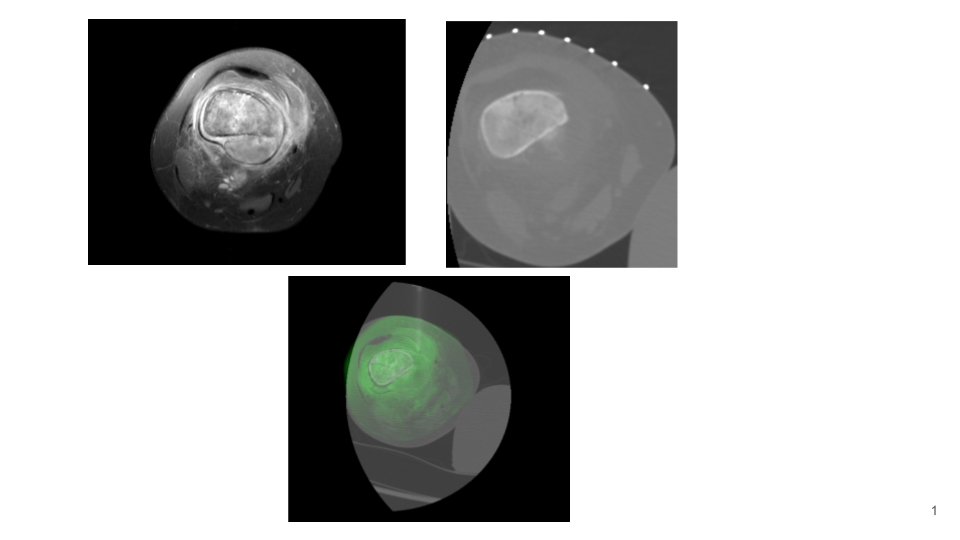 Ct Guided Biopsy Of Occult Soft Tissue Mass Igi Technologies